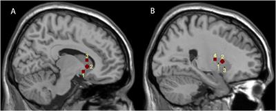 Motor Symptom Lateralization Influences Cortico-Striatal Functional Connectivity in Parkinson's Disease